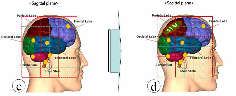 Sagittal plane 에서의 AVM 및 brain tumor 위치.