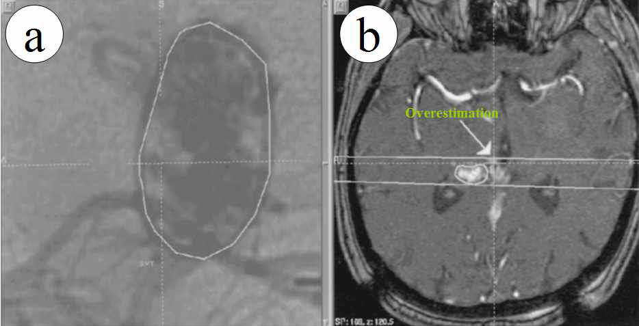 (a): Lateral angiogram showing outlines of an AVM nidus (solid white line). (b): MRA reveals vascular components (arrow) superimposed on the lateral projection of the nidus (solid white lines). This means the overestimation of the nidus volume on the lateral angiogram.