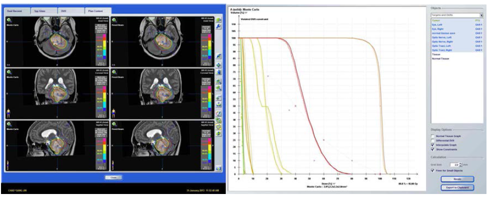 Planning Comparison between pencil beam and MC for radiosurgery of brainstem glioma