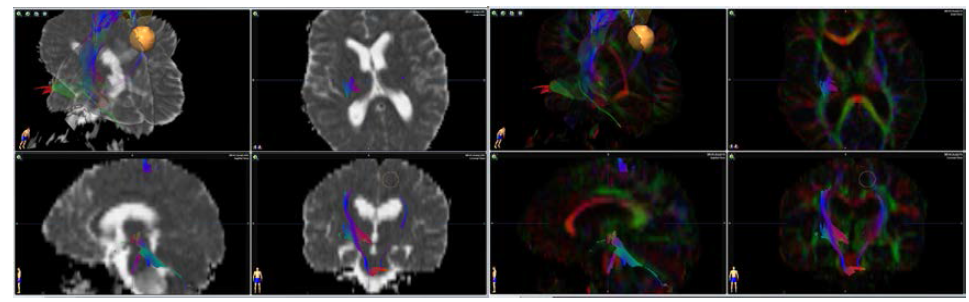 DTI(Diffusion tensor imaging)-based tractography and Arbitrary target volume.