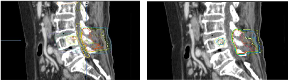 선량분포의 등 선량곡선 비교-sagittal image.