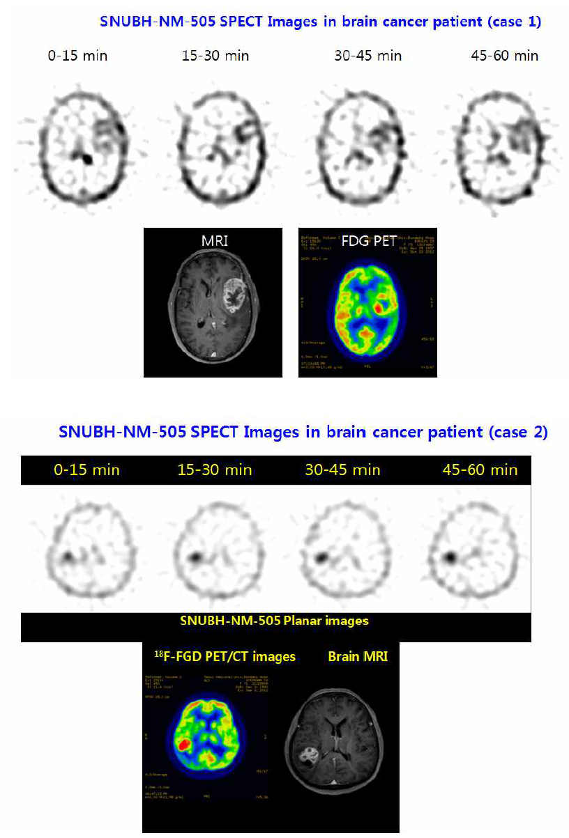 SNUBH-NM-505 뇌종양 환자를 대상으로 한 18F-FDG PET/MRI 영상과 비교 영상 평가 결과