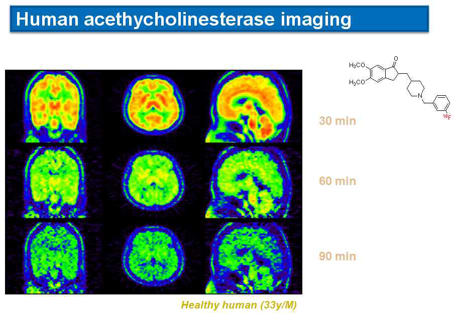 F-18 Donepezil의 Human imaging