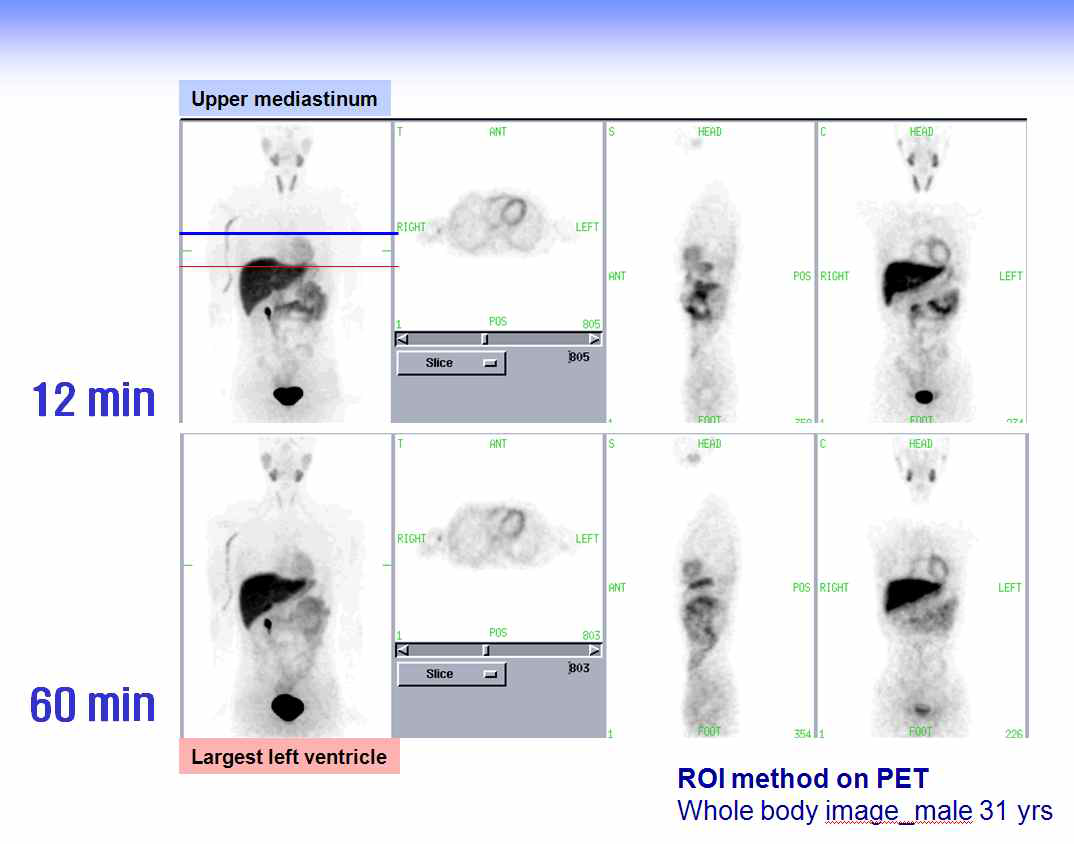 F-18 Guanidine의 정상 지원자에서의 whole body PET 영상 및 심장영상(12분, 60분)