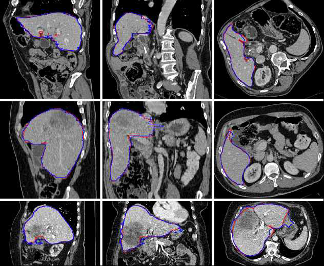 질환이 있는 간 CT 영상의 자동 분할 결과(파란색)와 수동 분할 결과/gold standard(붉은색)의 비교