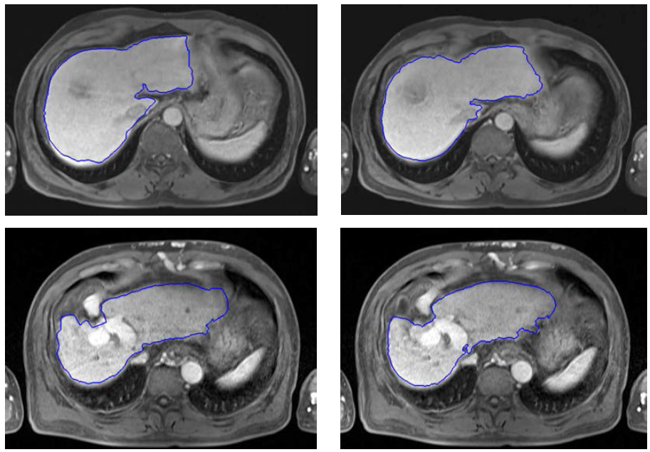 질환이 있는 간 MR 영상의 자동 분할 결과(파란색)