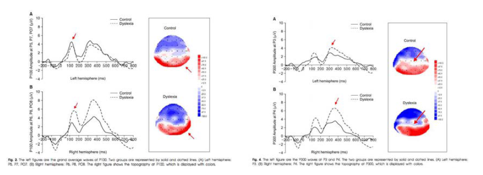 두 집단의 아동에게서 P100의 차이 (왼쪽). 두 집단의 아동에게서 P300의 차이.