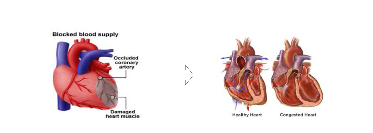 허혈성 심근경색(좌)과 심부전(우)의 병태생리