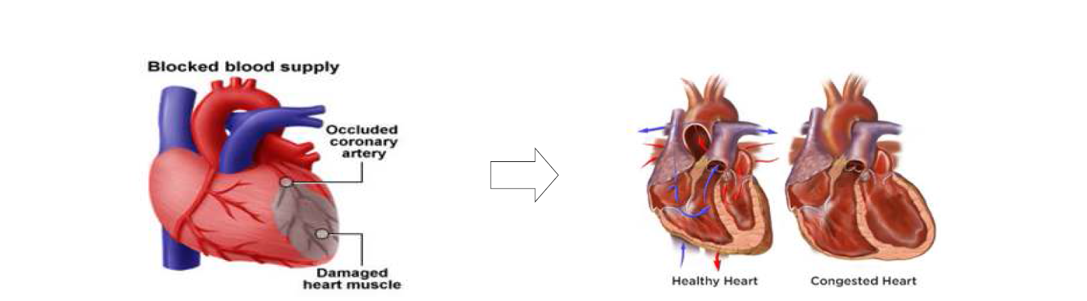 허혈성 심근경색(좌)과 심부전(우)의 병태생리