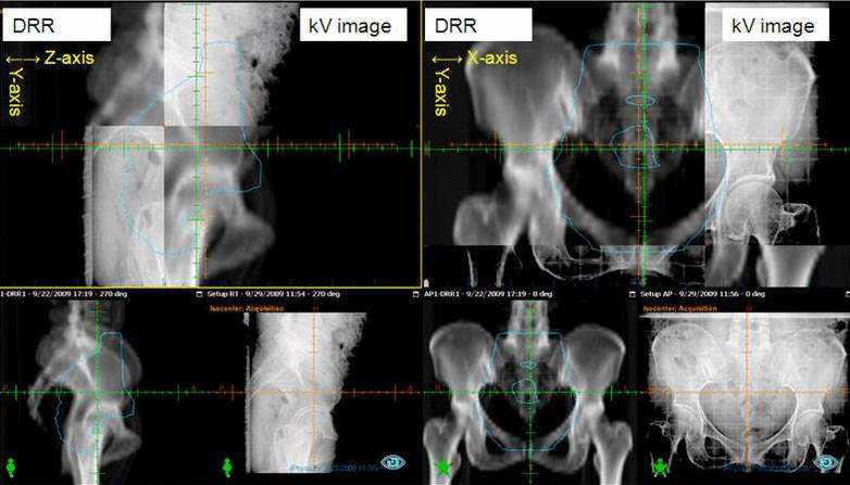 Digitally reconstructed radiograph for patient alignment in treatment room