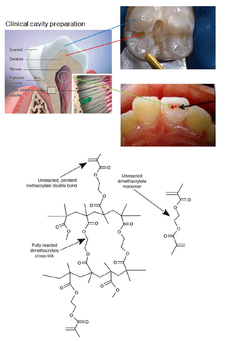 심미수복재의 구강내 사용조건(위) 및 미중합단량체의 용출(아래)