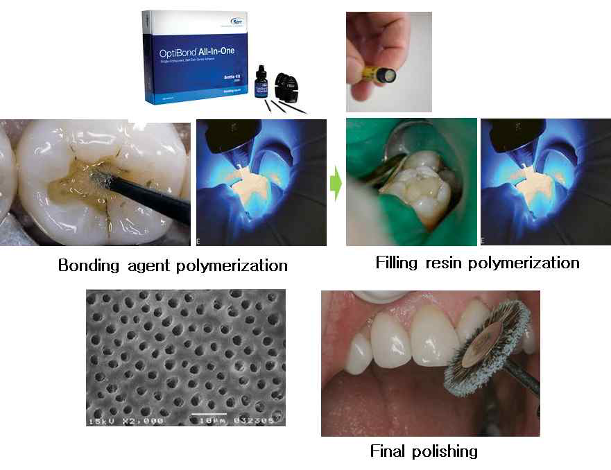 치과용 심미수복용복합레진을 이용한 우식치료 절차