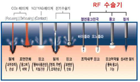 RF 수술기와 타 수술기의 차이