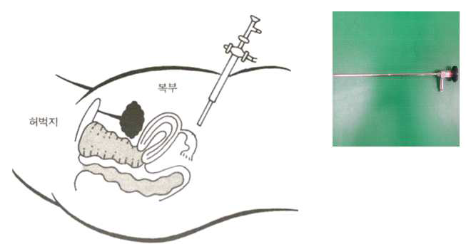 복강경 및 시술도안