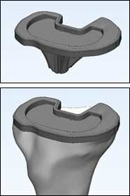 3차원 경골 모델을 기반으로 맞춤형 인공무릎관절 Tibial tray 설계