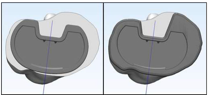 인공무릎관절 Tibial tray의 시술 모델