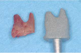 The extracted fractured tooth and the RAI before insertion in the fresh alveolar socket