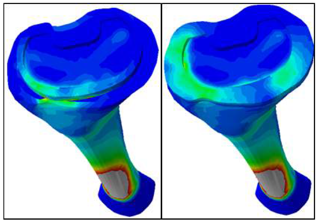 맞춤형 인공무릎관절과 기성 제품과의 유한요소 비교 결과