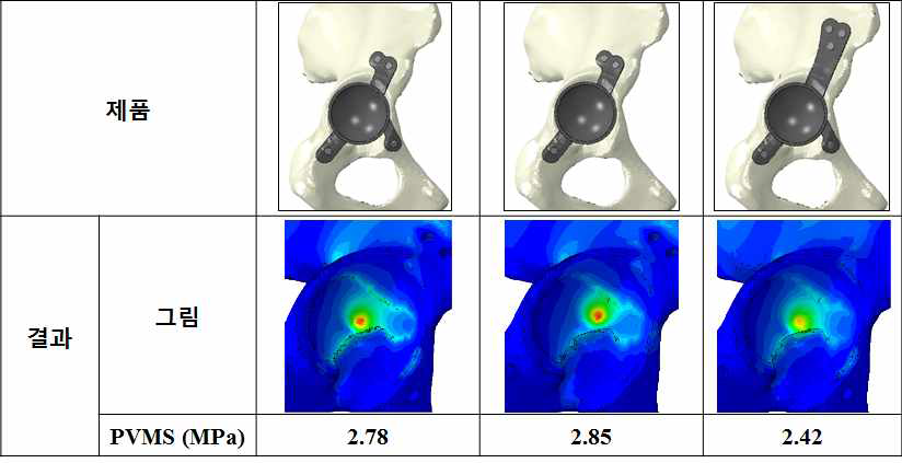 맞춤형 인공엉덩이관절의 유한요소 비교 결과 (골접합부)