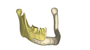 3D 프린팅 기술로 제작된 환자 맞춤형 하악골체.