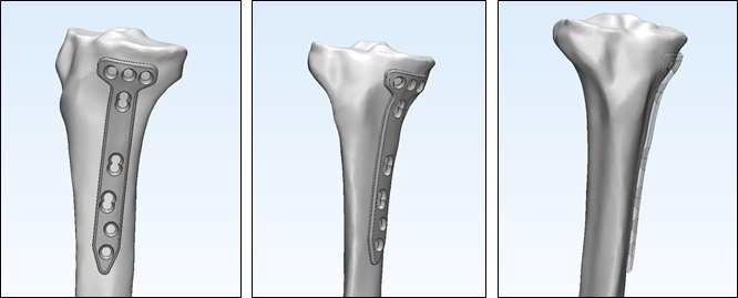 3차원 경골 모델을 기반으로한 맞춤형 골절합용판의 설계 예