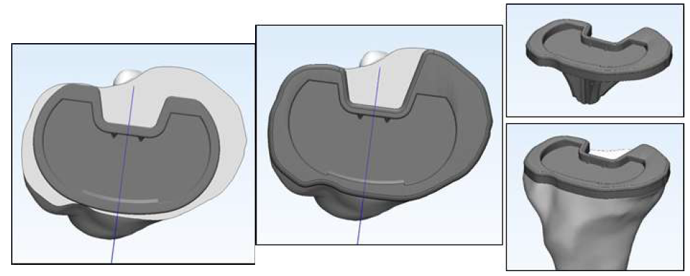 인공무릎관절 Tibial tray의 시술 모델