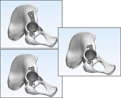 인공엉덩이관절 Pelvic component의 시술 모델