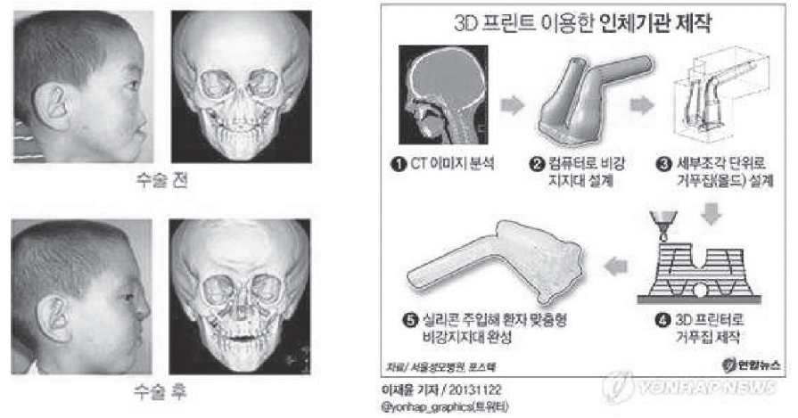 환자 수술 전후 사진(왼쪽), 기도 지지체 제작 과정(오른쪽)