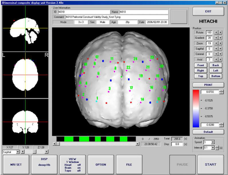 최대 확률 MRI 지도의 3D 피질 표면 영상으로 지형 데이터를 전사하여 얻은 광학 위치. 그림은 피질 표면에서 NIR 광원 (붉은 원), 탐지기 (파란 원), 그리고 채널 (자주색 원/녹색 번호)의 대략적인 위치를 보여준다