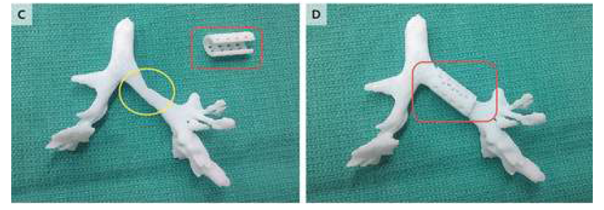 3D 프린팅된 부목과 3D 기도 모형 사진