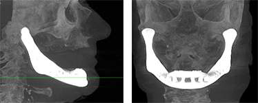 이식 후 X-ray 이미지