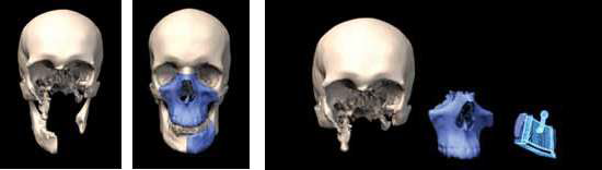 환자의 두개골 이미지와 뼈이식 영역 이미지