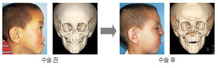 코뼈 수술 전·후 비교 사진