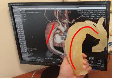 환자의 대동맥 3D 프린팅 모형