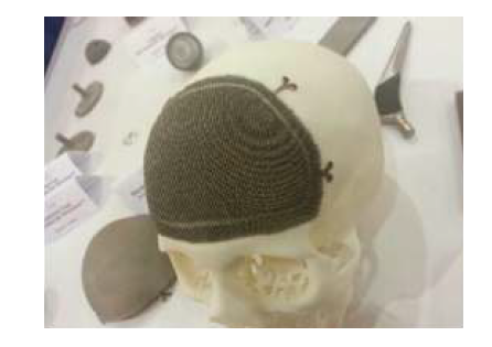 3D 프린팅된 인공 머리뼈