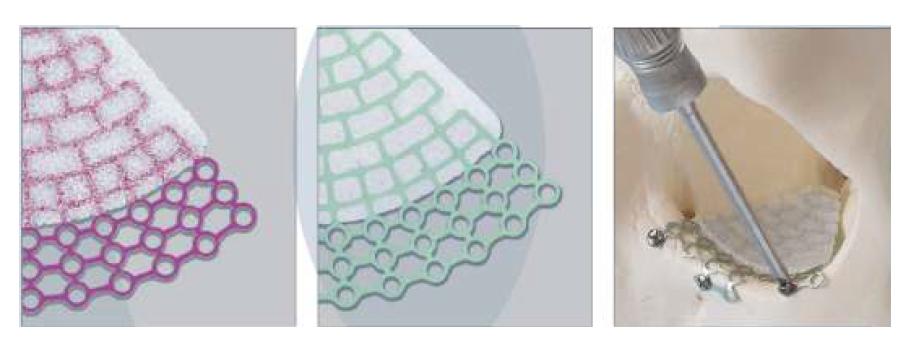 SYNPOR PROUS POLYETHYLENE IMPLANTS 이미지