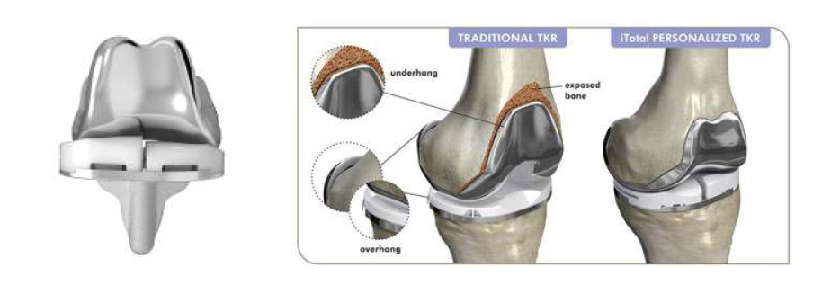 ConforMIS iTotal Cruciate Retaining Knee Replacement System