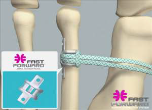 FastForward Bone Tether Plate