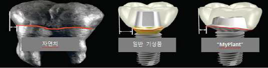 환자맞춤형 임플란트 비교