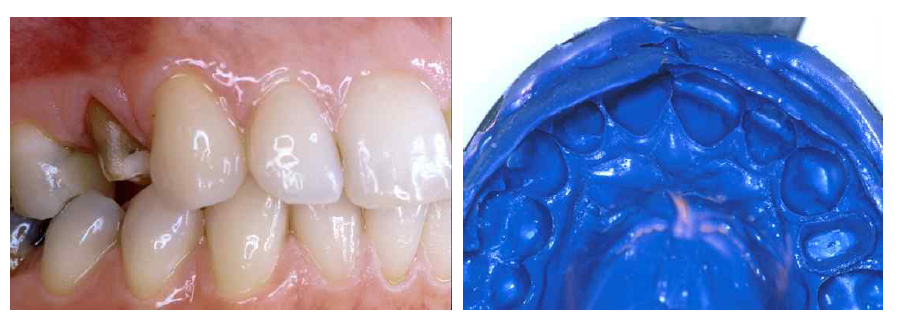 치과용폴리에테르인상재의 임상 증례