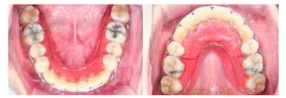 치과교정장치용레진의 사용 증례