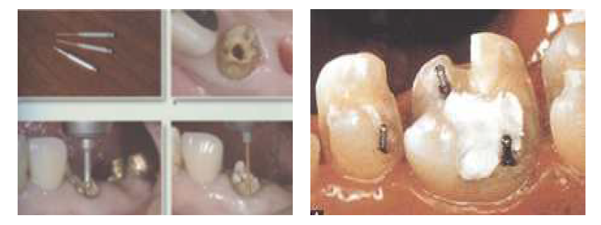 치과용유지용핀의 사용 증례