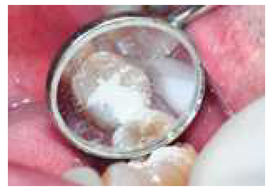 치과용산화아연유지놀시멘트의 사용 증례