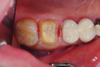 치과용하이브리드아이오노머시멘트의 사용 증례