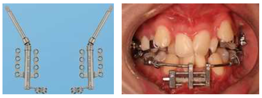 치과교정용골신연장치의 사용 증례