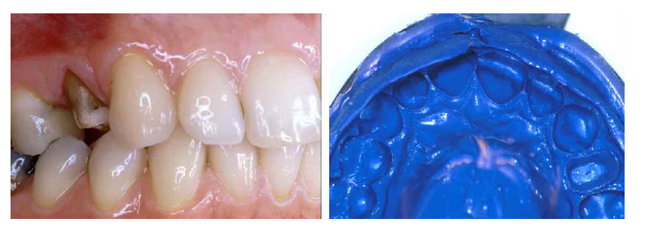 치과용폴리에테르인상재의 임상 증례