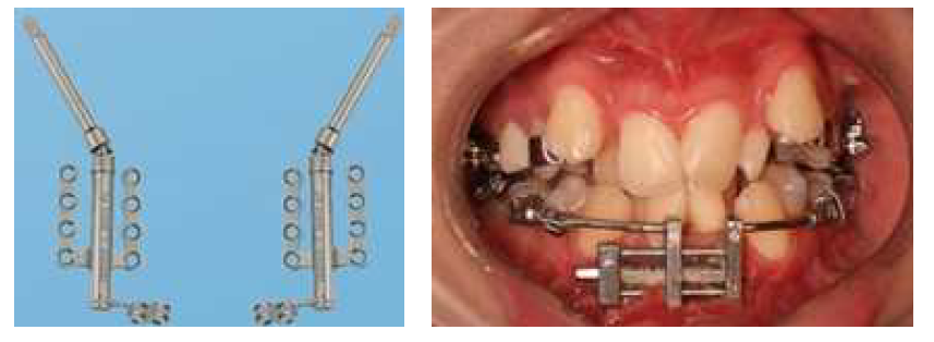 치과교정용골신연장치의 사용 증례