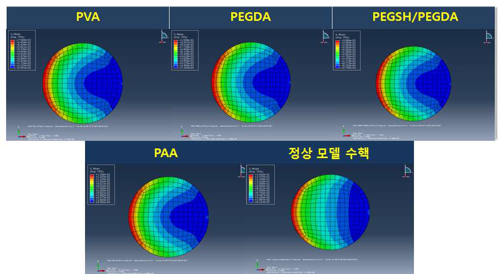 굽힘 하중에서 수핵 충진용 임플란트의 상부 부위의 응력 분포