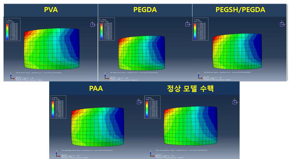 굽힘 하중에서 수핵 충진용 임플란트의 측면 부위의 응력 분포