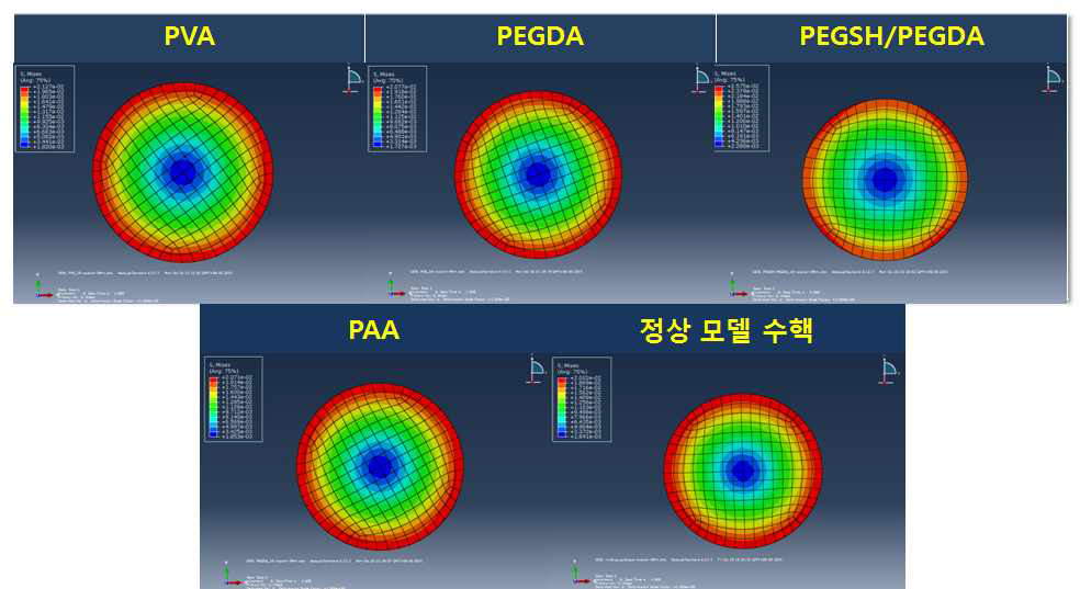 비틀림 하중에서 수핵 충진용 임플란트의 상부 부위의 응력 분포